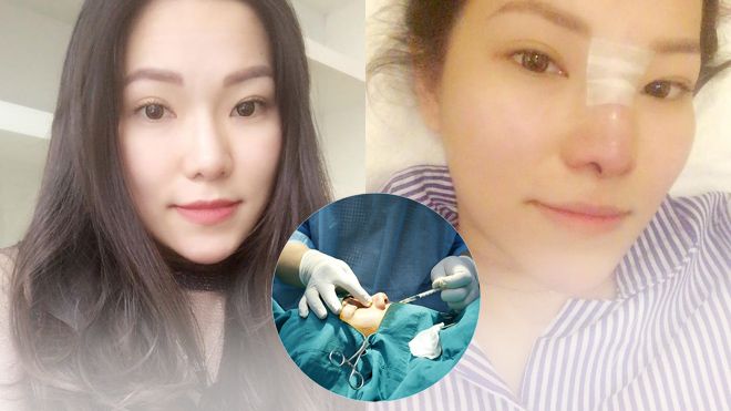 Lộ ảnh vợ cũ Lâm Vinh Hải phẫu thuật mũi và tiêm môi