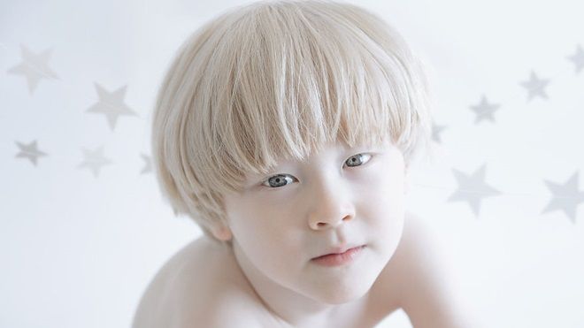 Vẻ đẹp thuần khiết như thiên thần của người bạch tạng