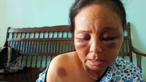 Bà bán tăm kể phút bị đánh bầm dập vì nghi bắt cóc trẻ em