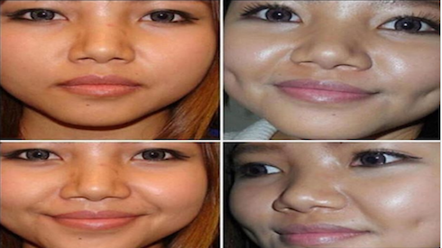 Thế hệ Y đổ xô đi phẫu thuật tạo má lúm đồng tiền