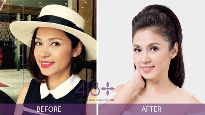 Bùng nổ xu hướng làm đẹp 2017 - Trẻ hóa da tác động sâu không dao kéo