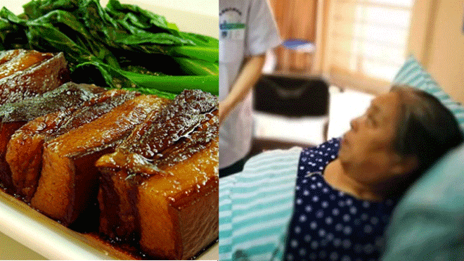 Trung Quốc: Phát hiện 806 viên sỏi mật trong bụng người phụ nữ ăn thịt ba chỉ và mỡ heo mỗi ngày