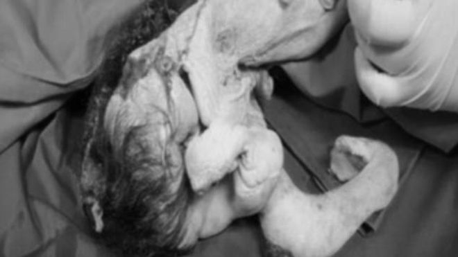 Mổ lấy khối u, bác sĩ choáng váng khi thấy tóc và dương vật trong dạ dày cậu bé 15 tuổi