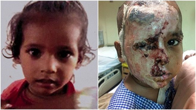 Mơ ước về gương mặt lành lặn của bé trai 2 tuổi bị kẻ biến thái tạt axit