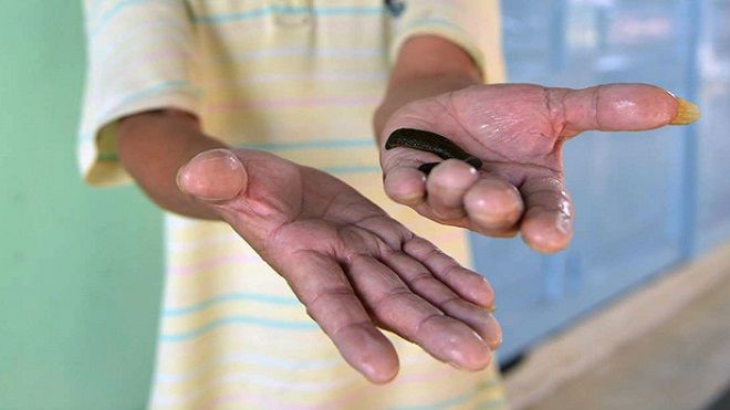 Đỉa theo nước ngập tấn công khu dân cư ở Sài Gòn
