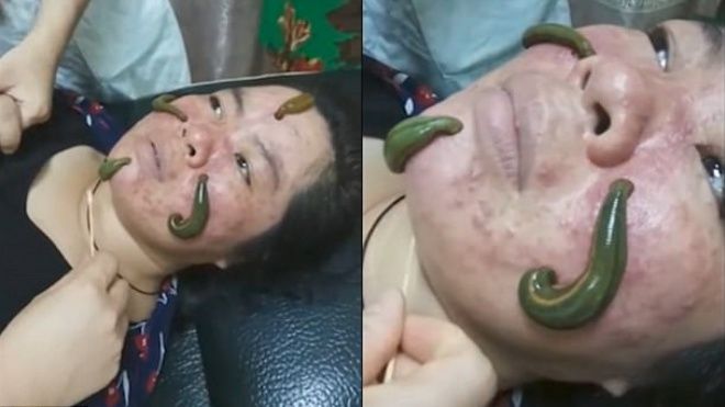 Cho đỉa bò lên mặt hút mụn - Làm đẹp kiểu kinh dị Trung Quốc chắc không ai dám thử