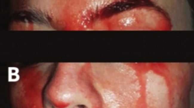 Cô gái trẻ cứ stress là bị toát mồ hôi máu khắp mặt mũi