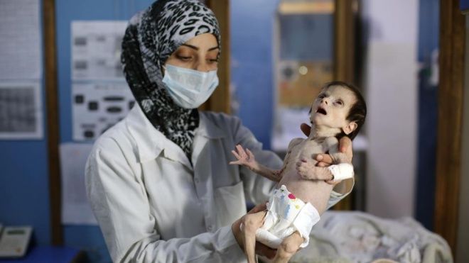 Bức hình em bé Syria gầy trơ xương, nặng chưa tới 2 kg và bi kịch chiến tranh chưa có hồi kết