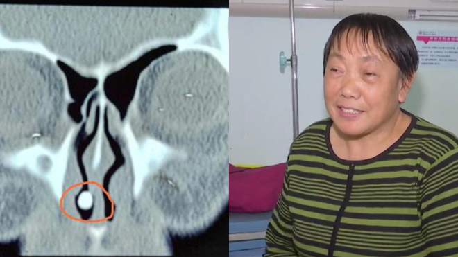 Hãi hùng răng mọc 'lạc' trong mũi