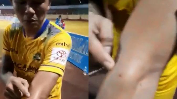 Cựu tuyển thủ Việt Nam tố bị ngoại binh cắn sưng tay
