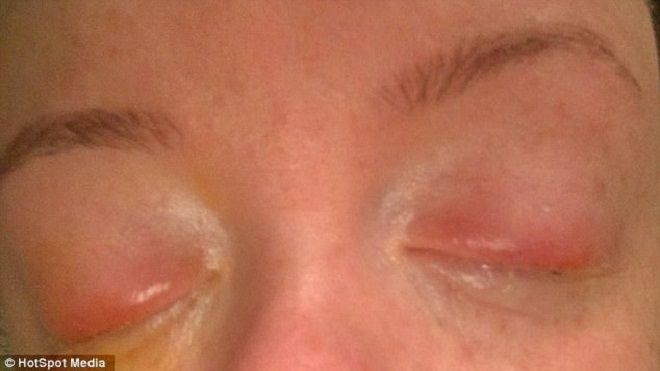 Thiếu nữ suýt bị mù vì hóa trang trong ngày Halloween