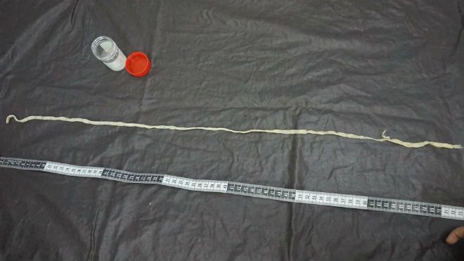 Cần Thơ: Gắp sán xơ mít dài 1,2m ra khỏi đại tràng bệnh nhân