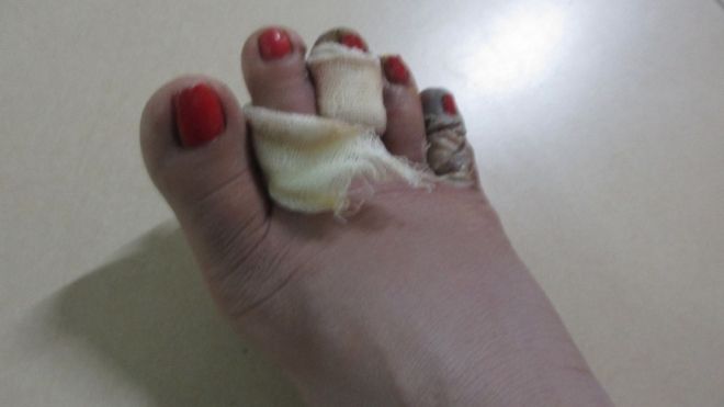 Người phụ nữ phải cắt bỏ 2 ngón chân sau khi bị chồng chích điện suýt chết