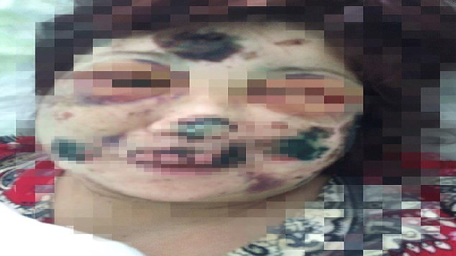 'Bữa tối tình yêu' kinh hoàng của người phụ nữ suýt mất mạng vì hẹn hò qua mạng