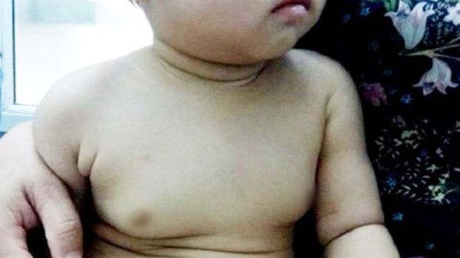 Mẹ hốt hoảng khi con gái 22 tháng tuổi có ngực to bất thường