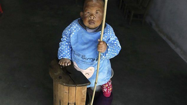 Người đàn ông 30 tuổi bị 'mắc kẹt' trong hình hài một đứa trẻ