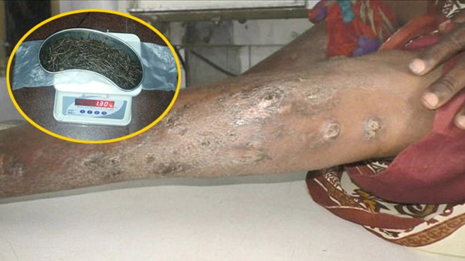 Kỳ lạ: Hơn 70 chiếc kim tiêm, kim khâu và đinh nhọn lần lượt trồi ra khỏi chân người phụ nữ