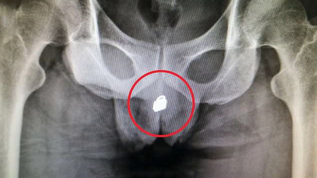 Người đàn ông bị ổ khóa mắc kẹt trong bàng quang vì sở thích chơi đùa với 'của quý'