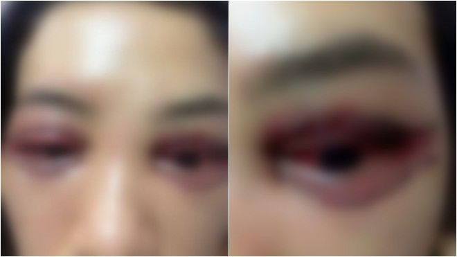 Khách nữ tố Spa cắt mí mắt hỏng còn bắt livestream xin lỗi: ‘2 bên đã tự hòa giải, mắt tôi không sao rồi’