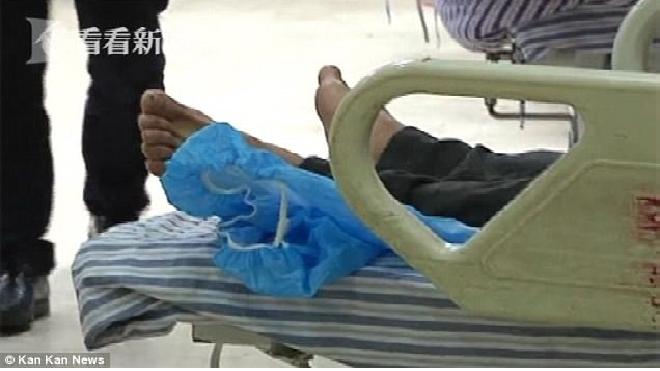 Bác sĩ 'suýt ngất' khi lấy vật thể lạ  trong bụng nam bệnh nhân