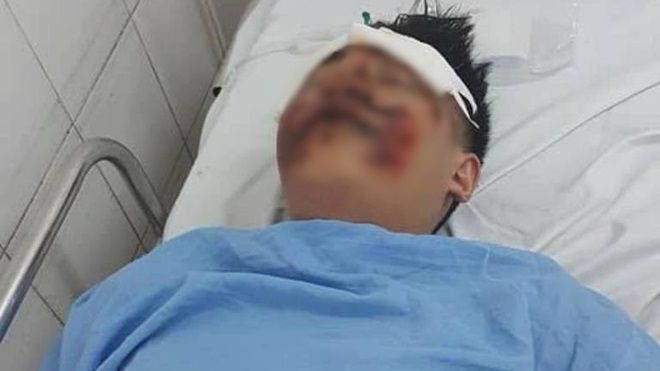 Truy tìm tài xế ô tô tông 2 sinh viên trường FPT chấn thương sọ não rồi bỏ chạy