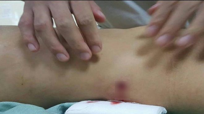 Cứu sống cô gái bị đạn xuyên thủng đại tràng khi đang đi đường