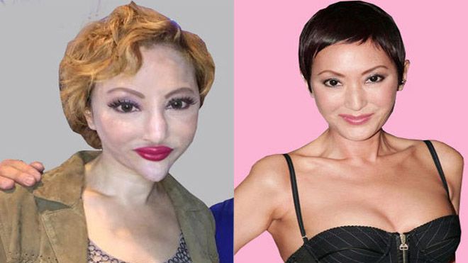 8 năm làm 'thảm họa mặt rắn' của mỹ nhân dao kéo Hồng Kông