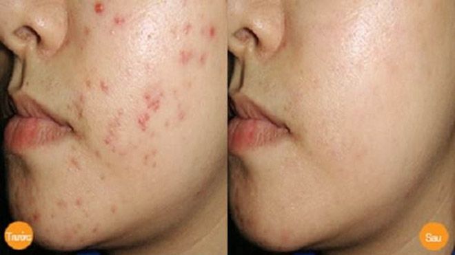 Mụn thâm nhiều chi chít cũng biến mất nhờ mẹo vặt này