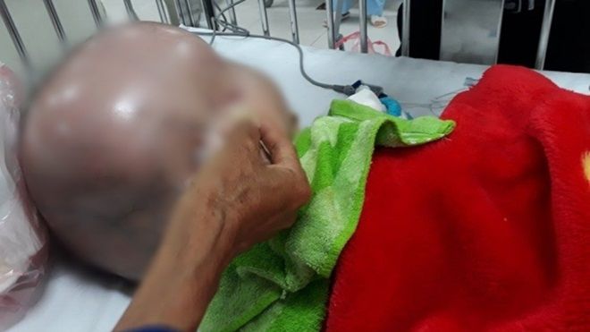 Bé trai 1 tuổi bị não úng thủy, đầu nặng 15kg ở Thanh Hóa đã qua đời