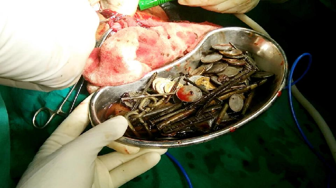 Bác sĩ suýt 'ngã ngửa' khi lấy 7kg dị vật trong bụng bệnh nhân