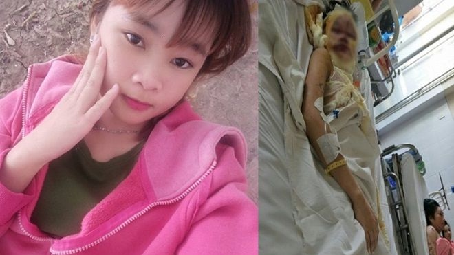 Đã bắt được nghi phạm tạt a xít khiến thiếu nữ 17 tuổi bị hủy hoại khuôn mặt