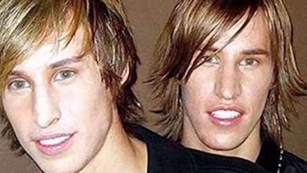 Sau cô gái phẫu thuật thẩm mỹ giống Angelina Jolie, lại thêm cặp song sinh 'dao kéo' để đẹp như Brad Pitt