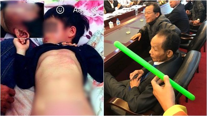 Vụ bé gái 4 tuổi bầm tím sau khi từ trường về: Do bị các bạn cùng lớp dùng thước đánh