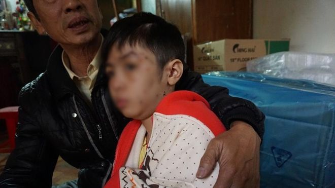 Vụ bé trai 10 tuổi bị bạo hành rạn xương sườn: Mẹ kế đã tới công an trình diện
