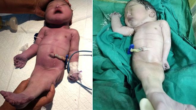 Mẹ sốc khi sinh con như người cá, 4 giờ sau lại nhận tin dữ