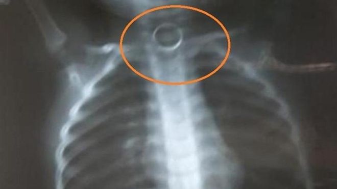 Cô giáo bất lực vì không có tiền chuyển viện cho con