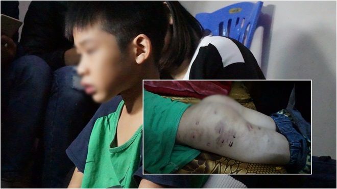Bé trai 9 tuổi nghi bị bố đẻ dùng dây điện đánh thâm tím cơ thể