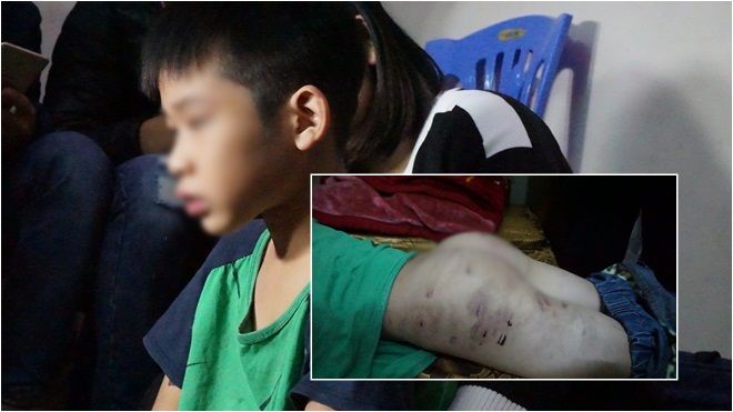 Chủ tịch Nguyễn Đức Chung chỉ đạo công an Hà Nội điều tra vụ bé trai 9 tuổi bị bố đánh thâm tím
