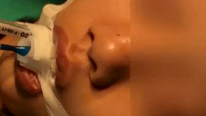 Bé gái 10 tuổi suýt chết vì mẹ nặn mụn đầu đen: Ai còn thói quen này hãy bỏ ngay