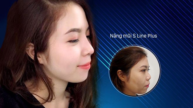Hàng loạt hotgirl thay đổi nhan sắc nhờ nâng mũi S Line Plus