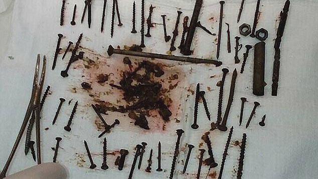 Bác sĩ suýt 'ngã ngửa' khi lấy 150 vật thể kim loại trong bụng bà lão