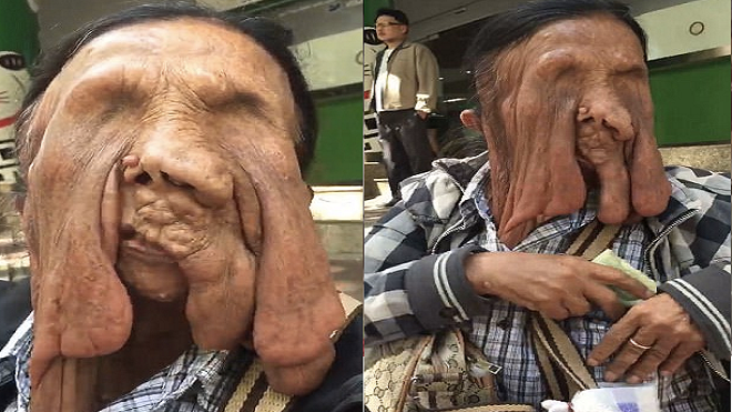 Cụ bà quyết không phẫu thuật, chấp nhận sống với khuôn mặt chảy xệ như yêu quái vì lý do bất ngờ