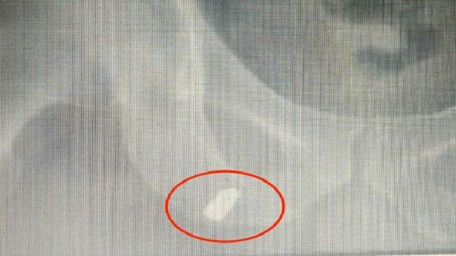 Bị đạn lạc găm trúng đùi khi đang làm đồng