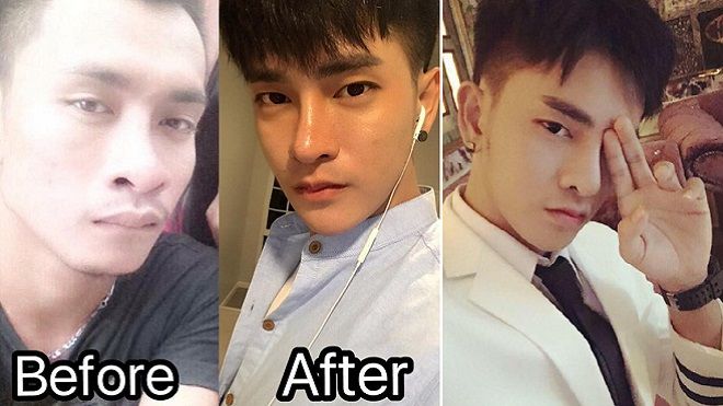 Chi hàng tỷ đồng và gần 30 cuộc phẫu thuật, chàng trai từng 'xấu như Lệ Rơi' đã có nhan sắc như idol Kpop