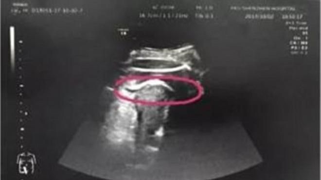 Thai nhi 8 tháng đạp thủng tử cung khiến mẹ suýt chết