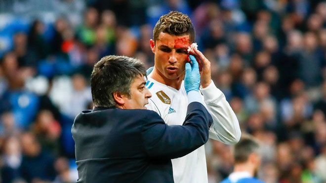 Ronalo gặp chấn thương suýt hỏng mắt khi lãnh trọn gầm giày của đối thủ