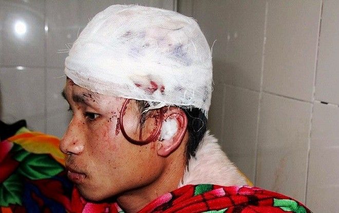 Giả vờ chết, nam thanh niên vẫn bị gấu tấn công rách đầu