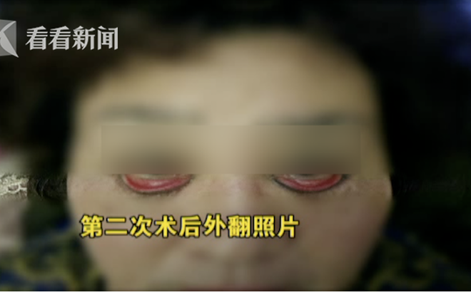 Ham mê phẫu thuật thẩm mỹ, người phụ nữ 60 tuổi không thể nhắm được mắt khi ngủ và có nguy cơ bị mù