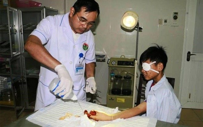 Học sinh lớp 2 bị thương nặng do nghịch pháo