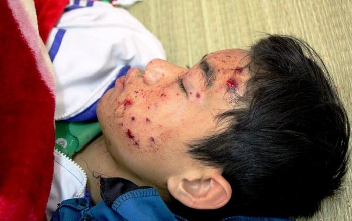 Nhiều mảnh vỡ găm vào nam sinh lớp 8 sau khi điện thoại phát nổ